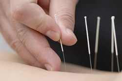 acupuncture needles on the back